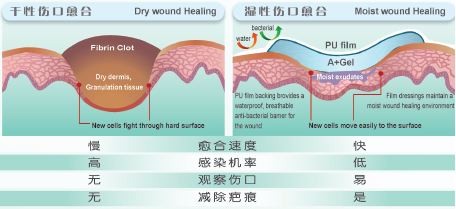 湿性伤口愈合