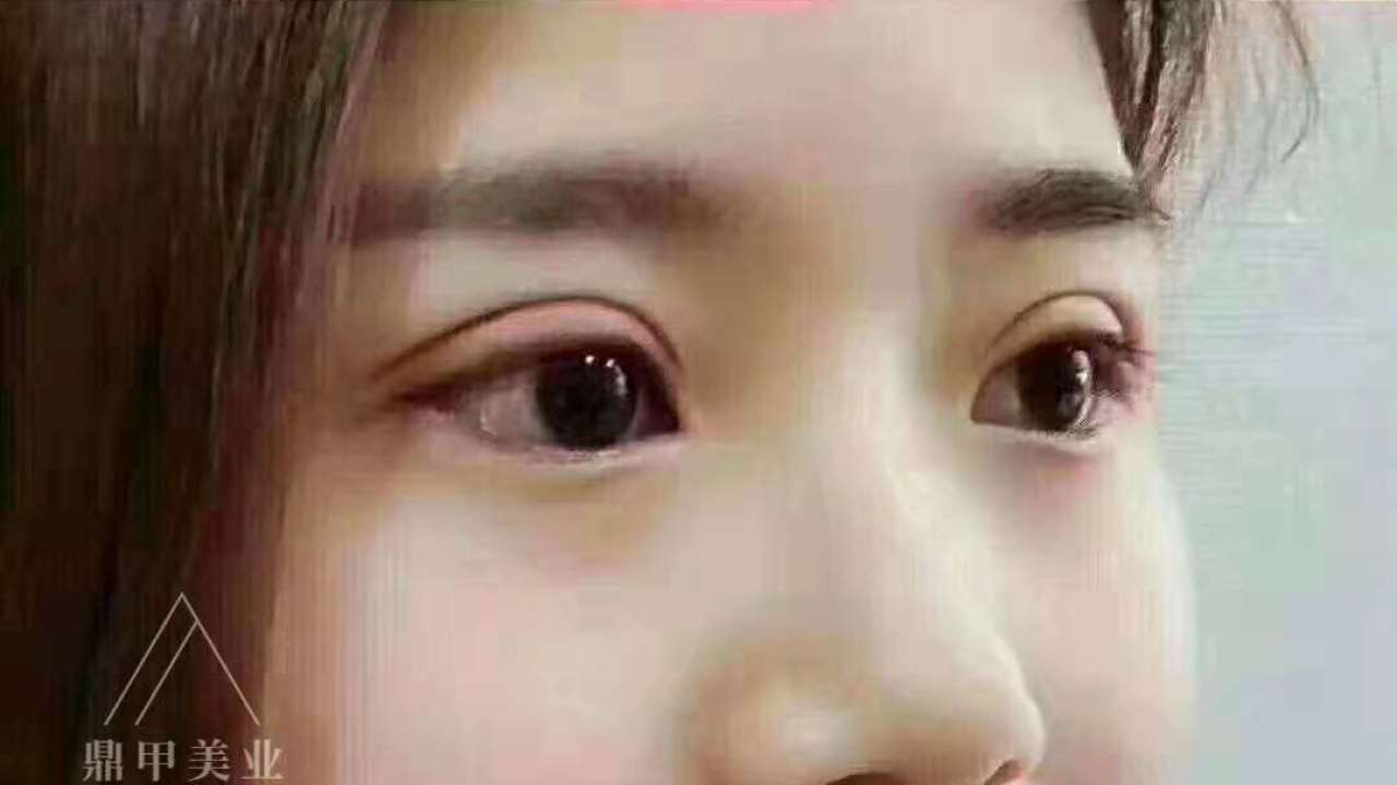 天生雙眼皮